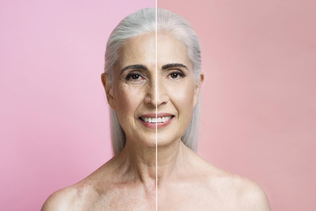 Before and after comparison of woman with facelift