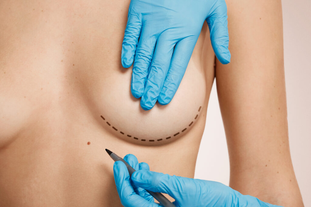 Woman marked out for surgery