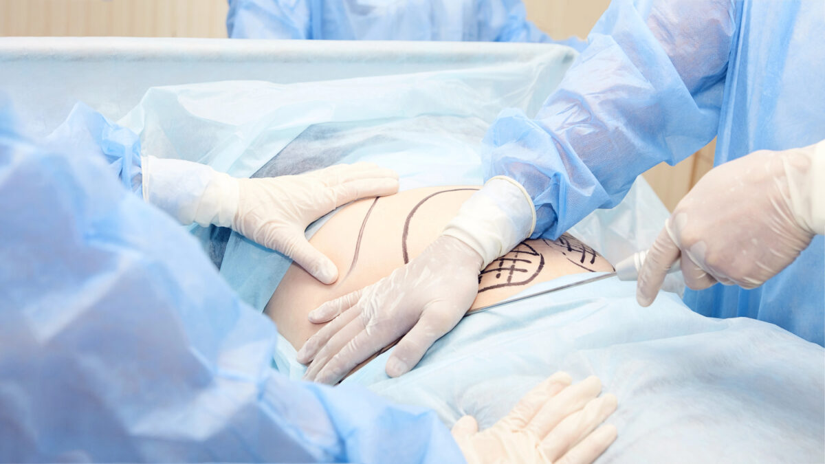 Anon person being prepped for abdominal surgery